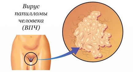 Eroziunea cervixului și a uterului (uterului) Eroziunea colului uterin și ipsosului.