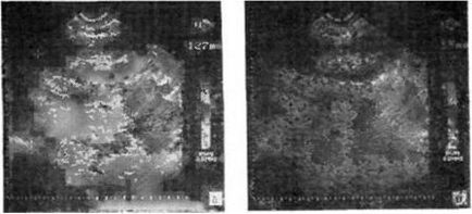 Echografie, examinare cu ultrasunete a rinichilor, uzi