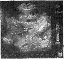 Echografie, examinare cu ultrasunete a rinichilor, uzi