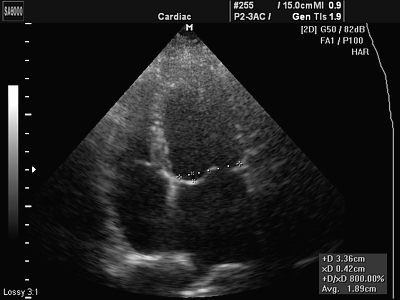 Az echokardiográfia (fals angina és szívzörej) - Rybakova m