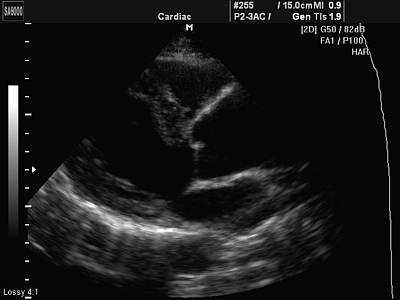 Echocardiografia (cauze cardiale și zgomote în inimă) - m. Pescarilor