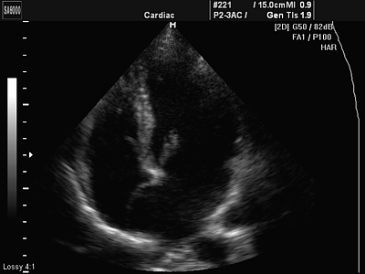 Echocardiografia (cauzele cardiogiei și zgomotelor din inimă) - m. Pescarilor