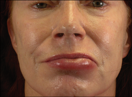 Töltőanyagok szövődmények bevezetése után az arcon ráncok, a szem alatti, az ajkak, miután a kontúr