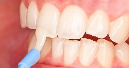 Флюоризацію зубів в харкові, ціни на флюоризацію (фторування) молочних зубів у дітей