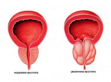 Formele și stadiile de prostatită acută catarrală, foliculară, parenchimală