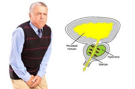 Formele și stadiile de prostatită acută catarrală, foliculară, parenchimală