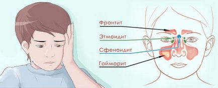 Фронтит у дітей симптоми і лікування, ознаки