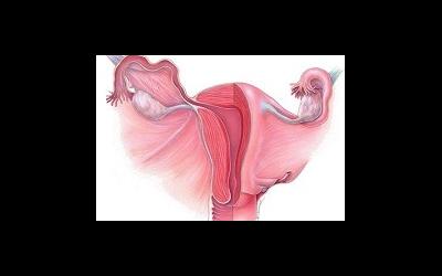 Hematometria uterului