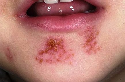 Herpesul de pe buze cauzează apariția, transmisă și tratată pentru tratament