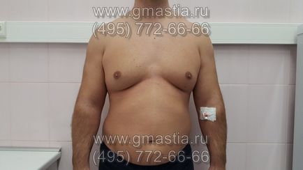 Gynecomastia művelet elkerülhetetlen