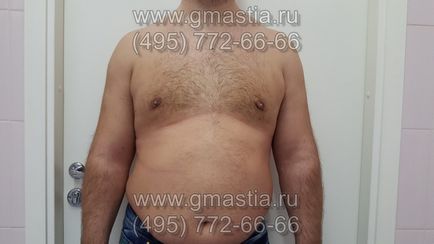 Gynecomastia művelet elkerülhetetlen (alsó határát a bimbóudvar) Gynecomastia művelet elkerülhetetlen