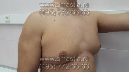 Gynecomastia művelet elkerülhetetlen