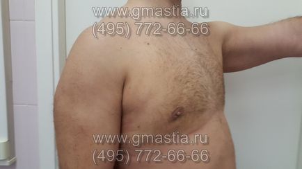 Gynecomastia művelet elkerülhetetlen