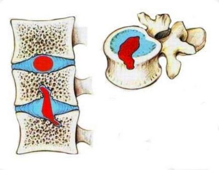 Herniated photo hernia