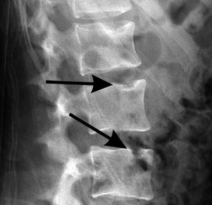 Herniated photo hernia