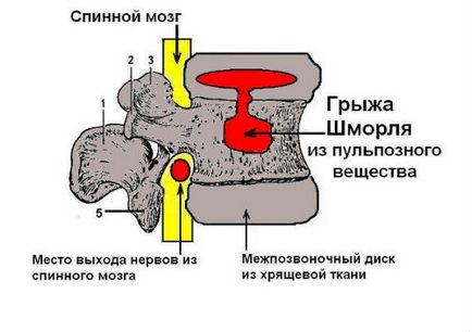 Herniated photo hernia