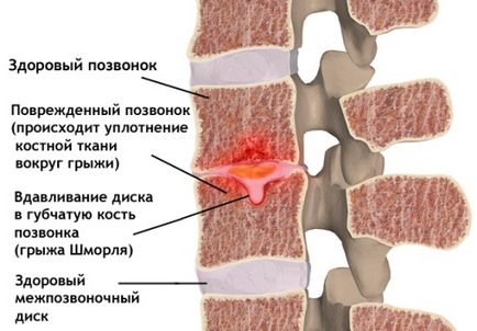 Herniated photo hernia