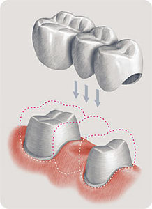 Proteze imediate