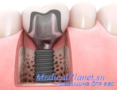 Іммедіат (термінові) зубні протези - свідчення, плюси, мінуси
