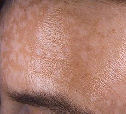 Scapa de pete de pigment pe fata remediilor populare, un remediu pentru pigmentarea pielii după