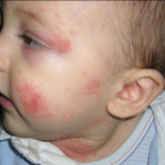 Cum de a trata dermatita atopică la adulți și copii 3 pași pentru victorie, sprosidermatologa