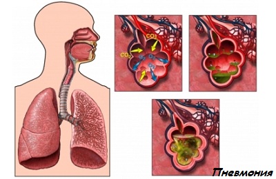 Який кашель при пневмонії у дорослих чим і як лікувати