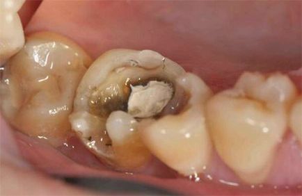 Cum să trageți arsenicul din dinți singur, cât timp ar trebui să fie
