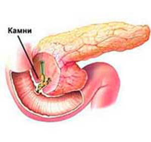 Pietrele în simptomele hepatice la femei, sănătatea femeilor