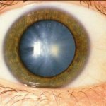 Prevenirea tratamentului pentru diagnosticarea cataractei - medicul dvs. aibolit