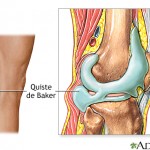 Кіста Беккера колінного суглоба опис, симптоми, лікування, фото і відео
