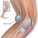 Кіста Беккера колінного суглоба опис, симптоми, лікування, фото і відео
