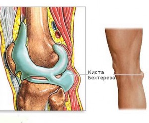 Кіста Беккера колінного суглоба опис, симптоми, лікування, фото і відео