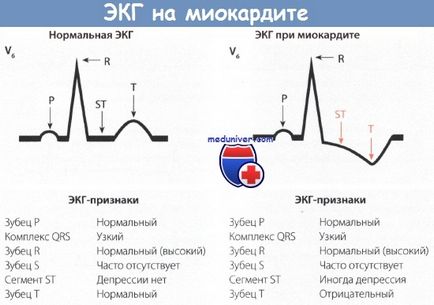 Клініка і ознаки міокардиту у дітей