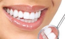 Compozite pentru dinți în stomatologie