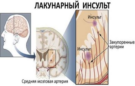 Lacunaris stroke-mi ez, iszkémiás, következményei, a kezelés