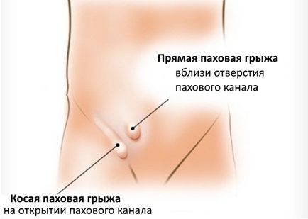 Лапароскопія пахової грижі показання, операція, ускладнення