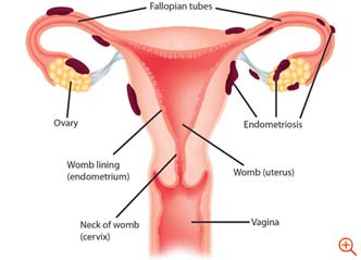Laparoscopie pentru endometrioză