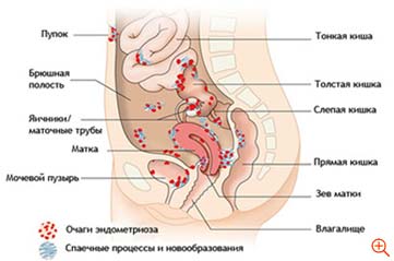 Лапароскопія при ендометріозі