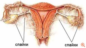 Laparoscopie pentru endometrioză