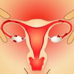 Laparoscopie pentru tratamentul și îndepărtarea endometriozei