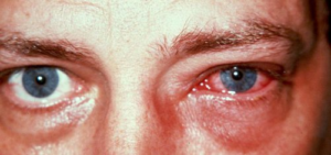 Tratamentul ochilor în chirurgia diabetului, prevenire