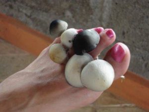 Лікування грибка нігтів часником, народні способи лікування