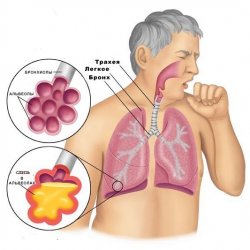 Tratamentul tusei pentru pneumonie - bisturiu - informație medicală și portal educațional