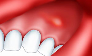 Tratamentul fistulei pe gingii și pe dinți