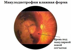 Макулодистрофія сітківки ока лікування, причини та народні засоби