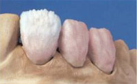 Металокераміка - популярний вид незнімного зубного протезування