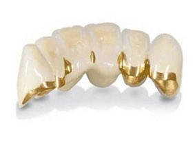 Metalloceramica - un tip popular de proteze dentare nedemontabile