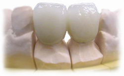 Металокераміка - популярний вид незнімного зубного протезування