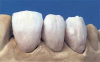 Metalloceramica - un tip popular de proteze dentare nedemontabile