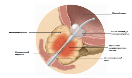 Centrul Medical Internațional uro-pro krasnodar - tratament termic in-uro-pro